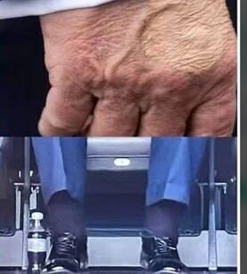 دونالد ترامپ چه بیماری دارد که بند کفشهایش را نمیتواند ببندد؟ +عکس