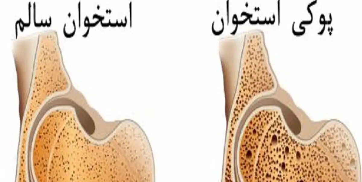 رتبه بیستم ایران در پوکی استخوان در دنیا؛ روزانه ۴۱۰ شکستگی!
