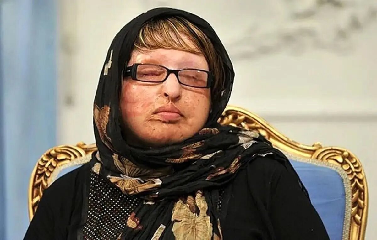 آمنه بهرامی؛ همچنان در تلاش برای دریافت دیه چشمانش/ اسیدپاش پیام داد: گفته بودم که بعد از آزادی هم دست ازسرتو برنمیدارم
 آمنه بهرامی؛ همچنان در تلاش برای دریافت دیه چشمانش/ اسیدپاش پیام داد: گفته بودم که بعد از آزادی هم دست ازسرتو برنمیدارم
