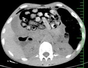 خروج ۹۰ بسته مواد مخدر از معده و روده یک بیمار +عکس