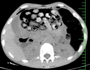 خروج ۹۰ بسته مواد مخدر از معده و روده یک بیمار +عکس