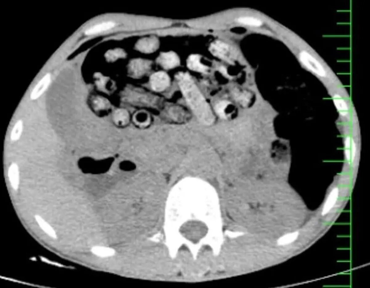 خروج ۹۰ بسته مواد مخدر از معده و روده یک بیمار +عکس