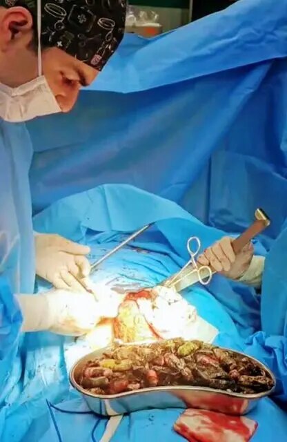 خروج ۹۰ بسته مواد مخدر از معده و روده یک بیمار +عکس