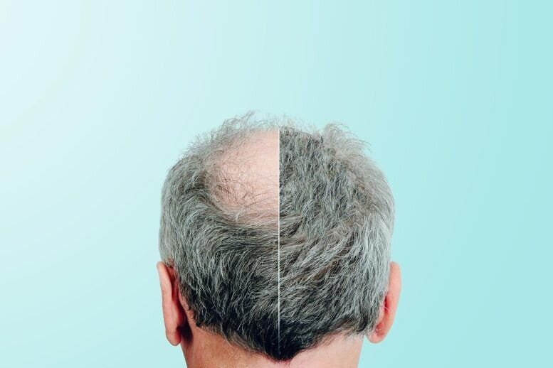 درمان جدید برای طاسی کشف شد