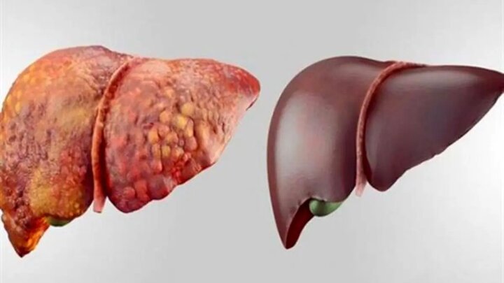 کبد چرب چگونه بهتر می شود؟ از این ۵ تغییر ساده شروع کنید