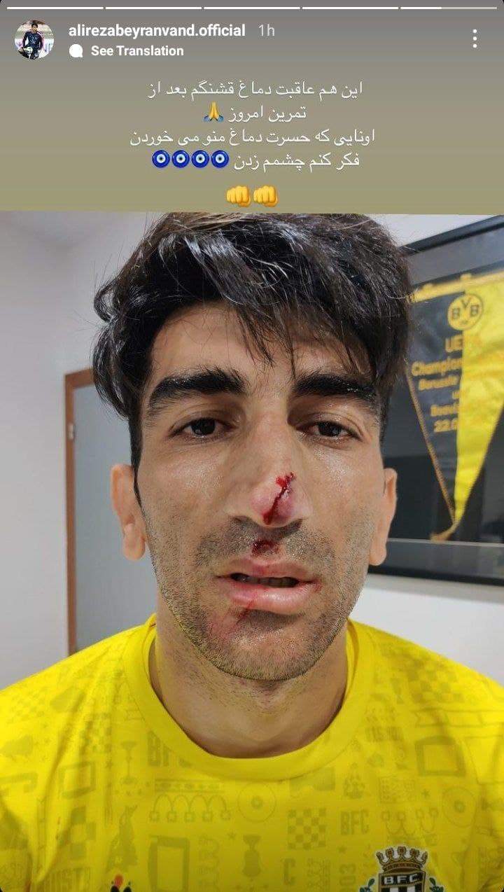 مصدومیت عجیب بيرانوند؛ دماغ قشنگم چشم خورد! +عکس مصدومیت عجیب بيرانوند؛ دماغ قشنگم چشم خورد! +عکس