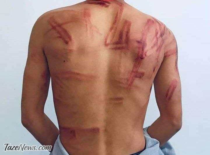 عکس دلخراش از زخم شلاق طالبان روی بدن خبرنگار بازداشت شده عکس دلخراش از زخم شلاق طالبان روی بدن خبرنگار بازداشت شده