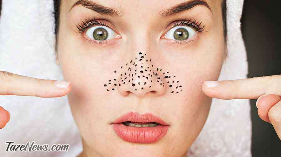 راه‌های ازبین بردن جوش‌های سرسیاه