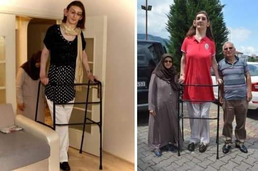 دختر ۲۴ ساله از ترکیه بلندقدترین زن جهان شد +عکس و ویدئو