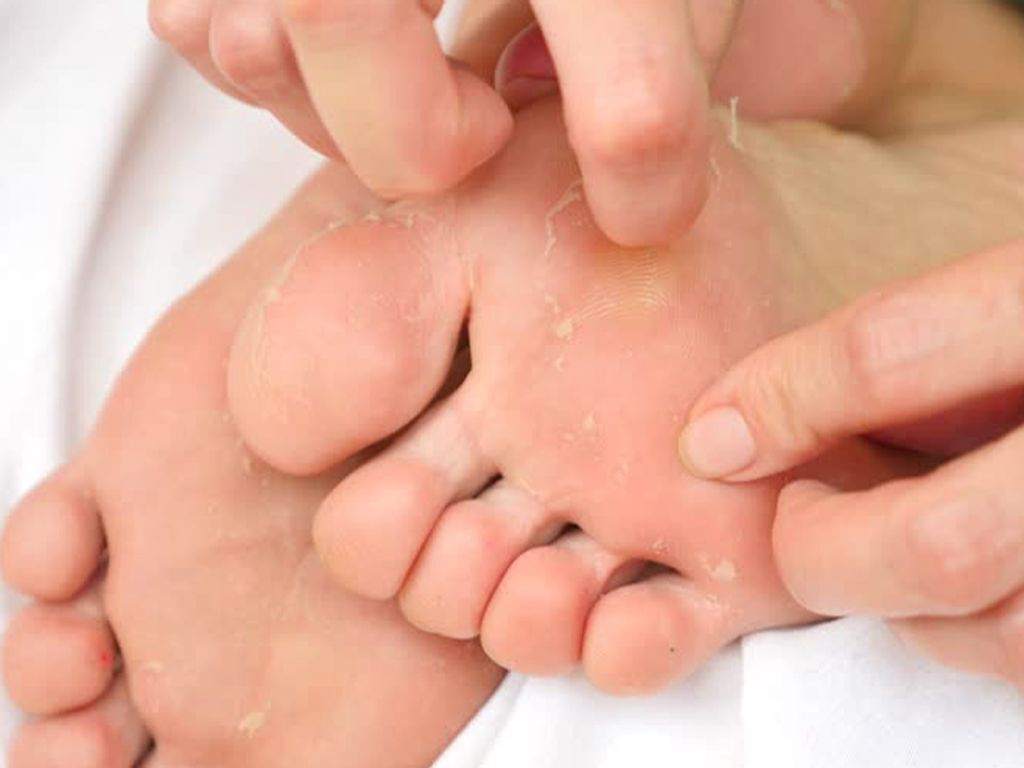 دلایل پوسته پوسته شدن کف پا