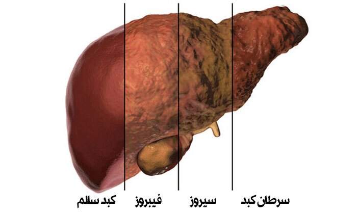عامل مهم بروز کبد چرب چیست؟ عامل مهم بروز کبد چرب چیست؟