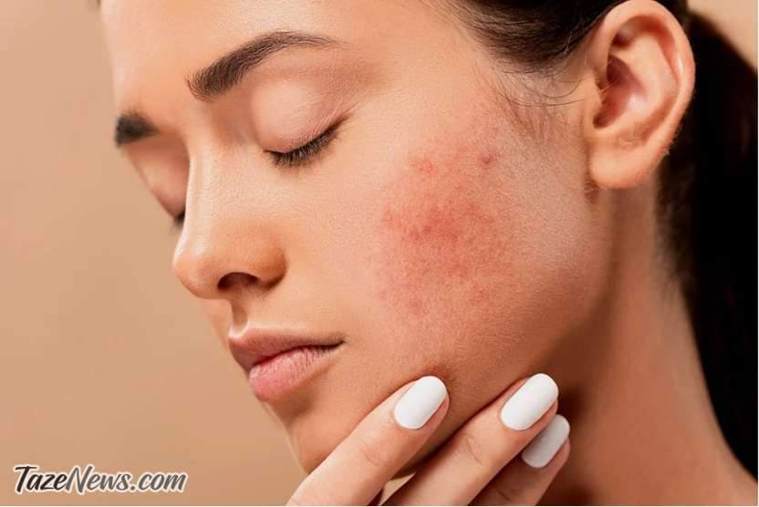 استرس با پوست ما چه میکند؟ استرس با پوست ما چه میکند؟