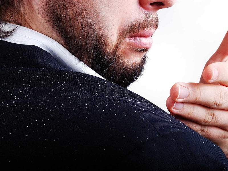 چرا شوره سر در زمستان بیشتر می‌شود؟