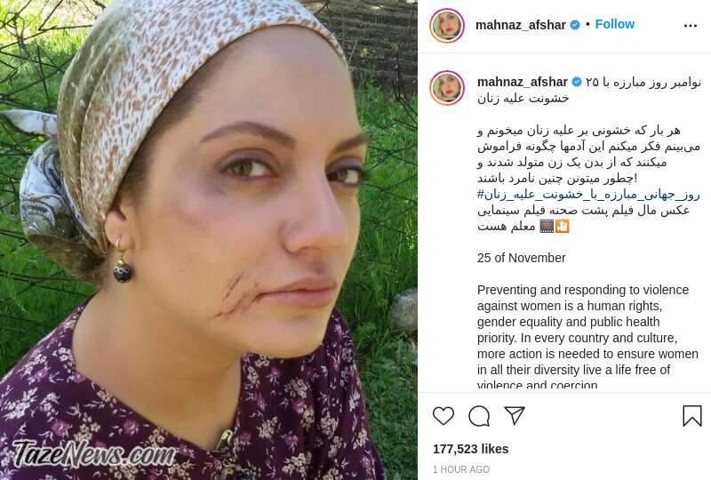 عکس| مهناز افشار با صورت کبود عکس| مهناز افشار با صورت کبود