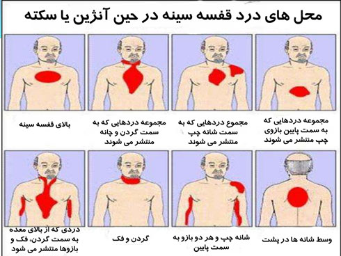 با انواع سکته قلبی و علائم آن آشنا شوید
