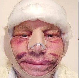 عاقبت وحشتناک عمل بوتاکس یک پیرمرد +تصاویر