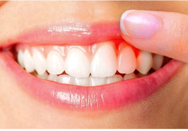 ورم لثه چیست و چه درمانی دارد؟ ورم لثه چیست و چه درمانی دارد؟