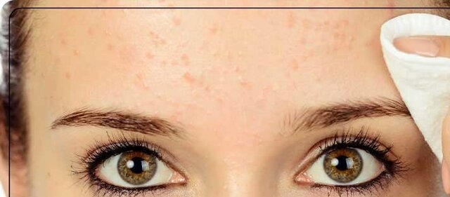 چگونه جوشهای زیرپوستی را درمان کنیم؟ چگونه جوشهای زیرپوستی را درمان کنیم؟