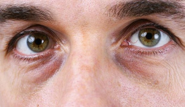 روش ساده برای از بین بردن سیاهی زیر چشم