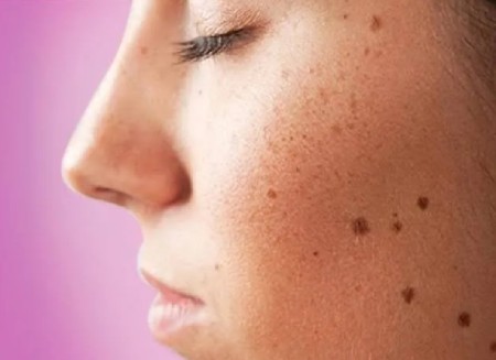 خال سرطانی را چطور میتوان تشخیص داد؟ خال سرطانی را چطور میتوان تشخیص داد؟