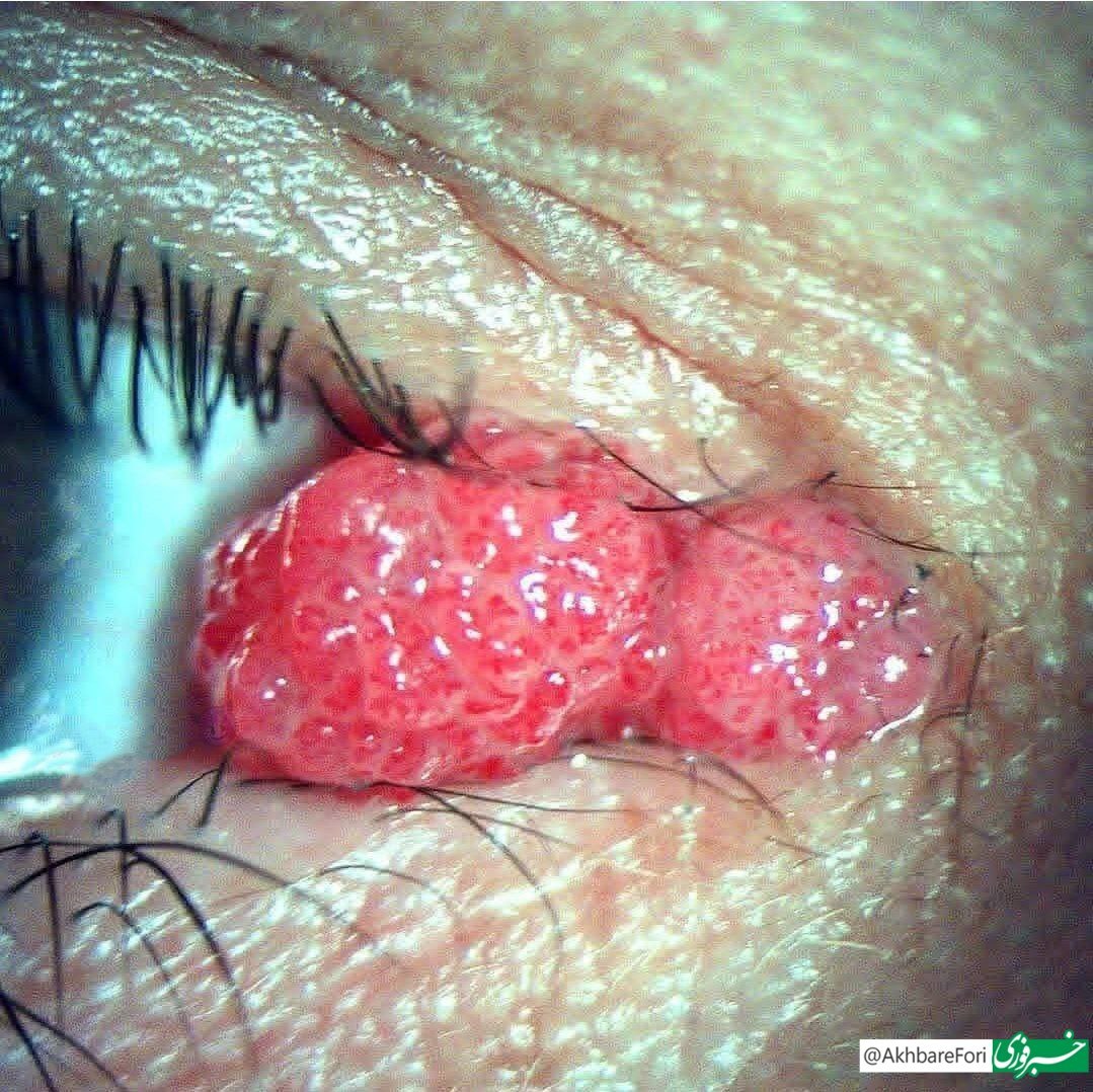تصویری وحشتناک از چشم مبتلا به ویروس HPV!